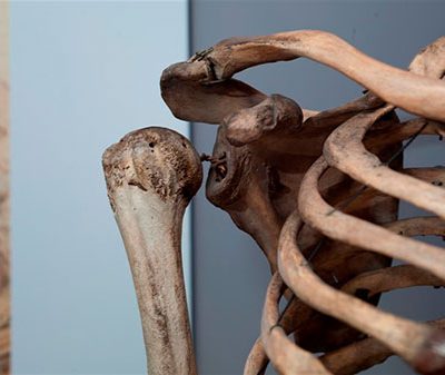 Detail from skeleton of Charles Byrne (Royal College of Surgeons)