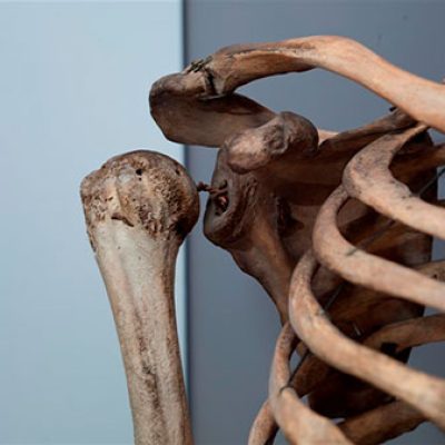 Detail from skeleton of Charles Byrne (Royal College of Surgeons)